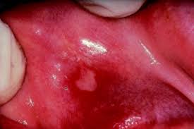 mouth ulcers and other causes of