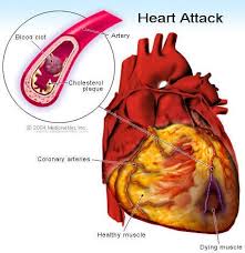 What Is Coronary Artery Bypass Graft Surgery Grafting