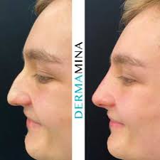 how are non surgical nose jobs possible