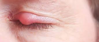 eyelid pain 5 reasons why your lids