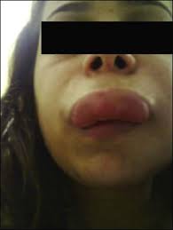 severe edema on the upper lip with