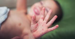 Among the states and federal territories affected by the outbreak, selangor recorded the highest cases with 11,349, kuala lumpur with. Hand Foot And Mouth Disease Fv Hospital