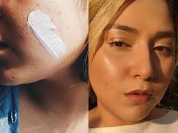 worst sunscreens for oily acne e skin