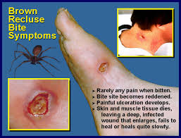 brown recluse spider bite symptoms