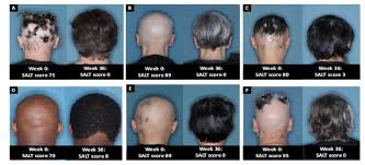 first alopecia treatment for autoimmune