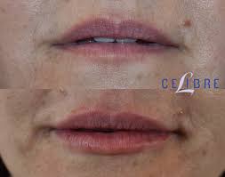 juvederm before and after pictures of