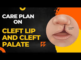 care plan on cleft lip and cleft palate