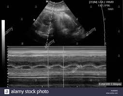 M Mode Ultrasound Measuring A Normal Fetal Heart Rate Stock