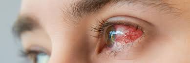 the most common eye infections