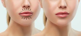 thin lips treatments calgary