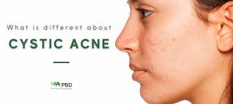 cystic acne is diffe from regular acne