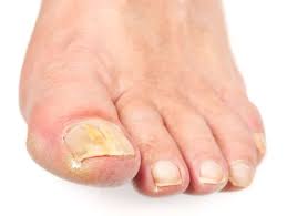 toenail fungus remes reported cures