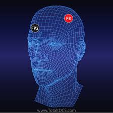 Depression And Anxiety Total Tdcs Electrode Placement