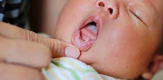 newborn thrush vs milk tongue how to