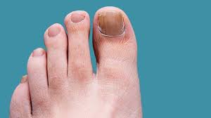 toenail and foot fungus