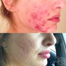 this developed severe cystic acne