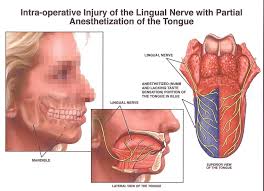 wisdom teeth nerve damage boston