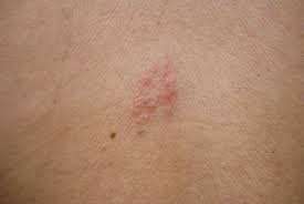 shingles rash pictures