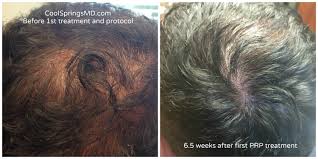 hair restoration before and after pictures bwood tn