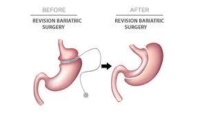 revision bariatric surgery dr