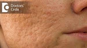 remove acne scars by natural remes