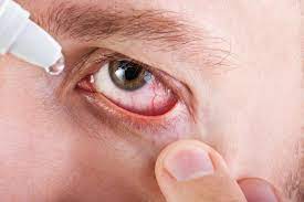 top causes of bloodshot eyes decarlo