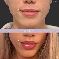 lip lift nyc lip specialist new york