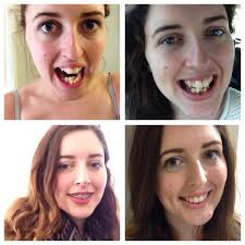 I got the damon braces. 15 Drastic Transformations Of People Before And After Braces