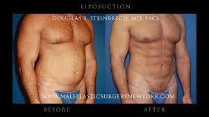 liposuction cost understand the