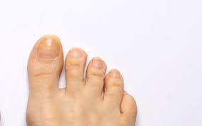 treatment options for yellow toenails