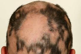 hair loss symptoms causes and treatment