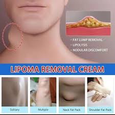 curskin lipoma treatment ointment ebay