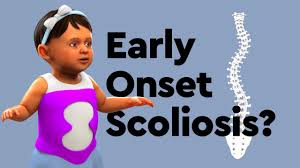early onset scoliosis children s