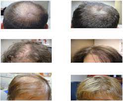 It is being used to effectively treat the genetic forms of hair loss common in men and women, such as androgenetic alopecia or pattern balding. Low Level Laser Therapy Lllt For Hair Loss Ava Laser Clinic