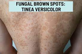 tinea versicolor brown spots or white