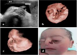 prenatal 3d ultrasound diagnosis of