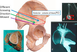 Abdominal and pelvic anatomy encompasses the anatomy of all structures of the abdominal and pelvic cavities. Iliac Screw For Reconstructing Posterior Pelvic Ring In Tile Type C1 Pelvic Fractures Sciencedirect