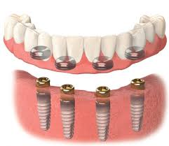 Implant-Supported Dentures that don't slip - Rancho San Diego Dental