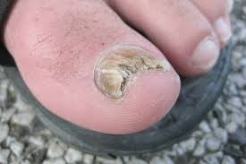 toenail problem an important guide to