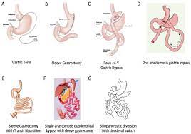 bariatric surgery procedures listed in