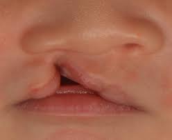 cleft lip and palate in children