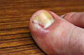 permanently fixing ingrown toenails in