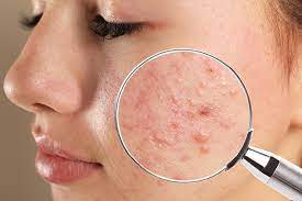 pitted acne scars