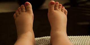 swollen feet during pregnancy what
