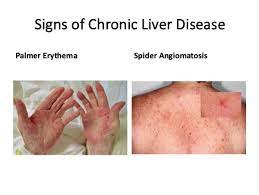 the liver liver insute pllc