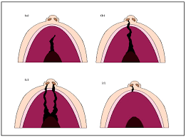 oro clefts genetics of cleft lip
