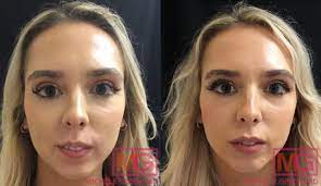 lip fillers before after photos dr