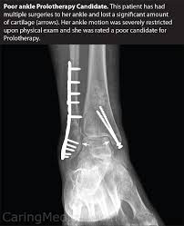 ankle replacement surgery