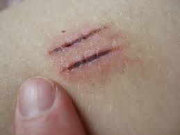 Image result for Cuts & Bruises