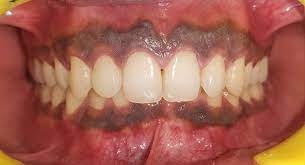 Prevalence of Gingival Pigmentation and its Association with Gingival Biotype and Skin Colour
